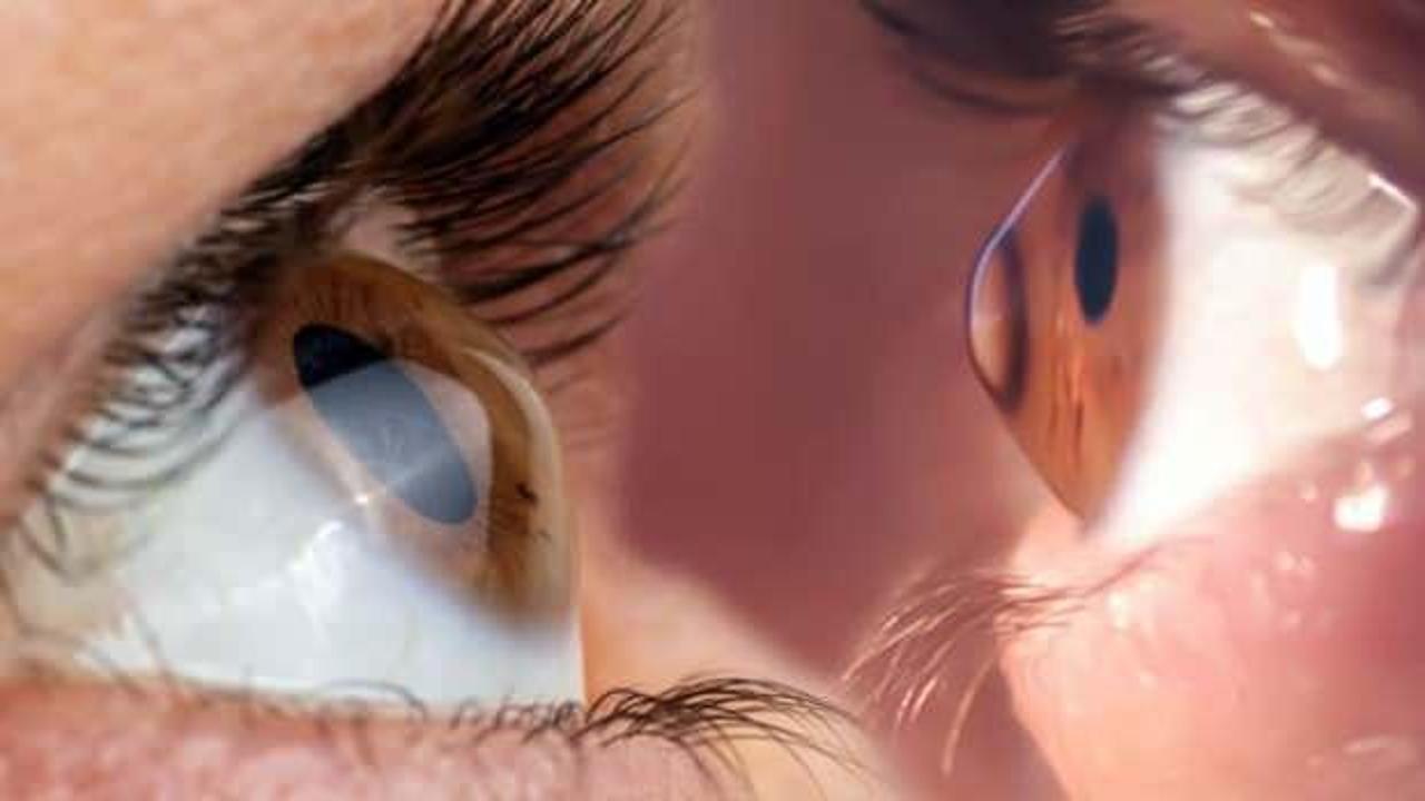 Prof. Dr. Levent Akçay keratokonus hastalığına karşı uyarıyor!