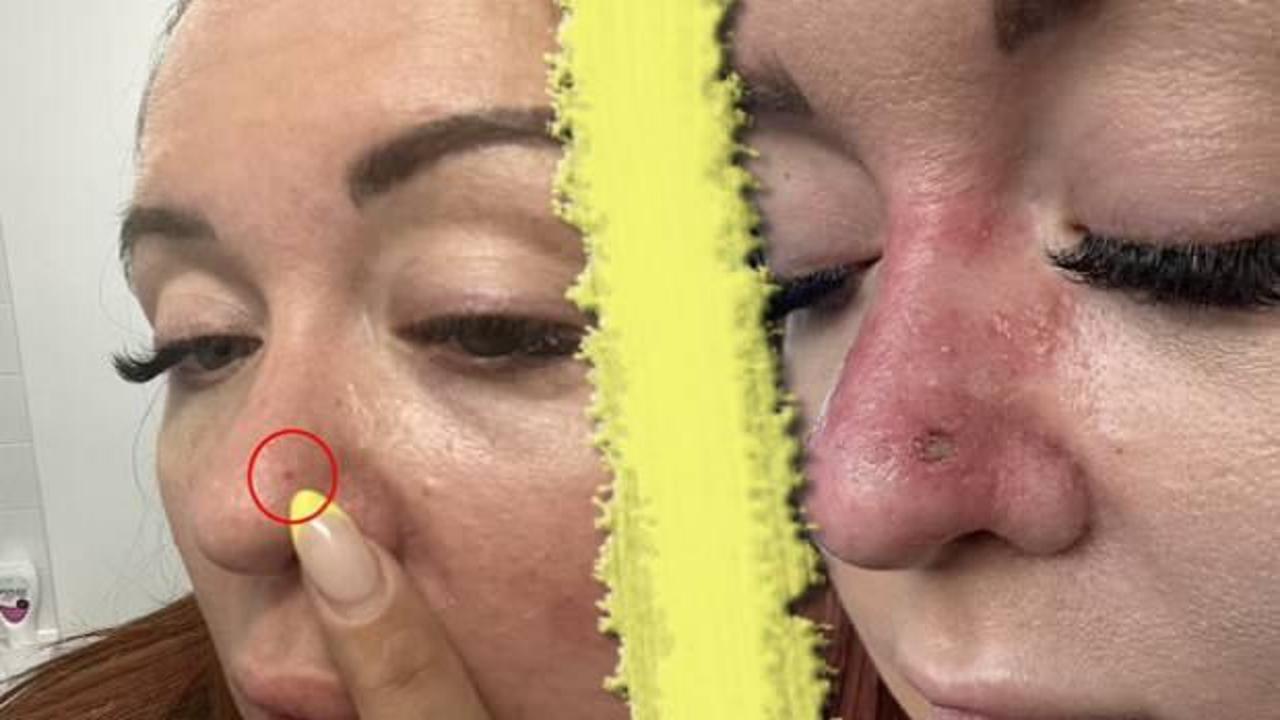 Sıradan bir sivilce sandı, gerçek ortaya çıkınca şoke oldu! O küçük şişlik meğerse…