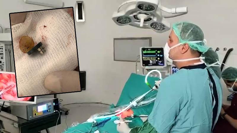 3 mıknatıs yutan 1,5 yaşındaki Faruk, laparoskopi destekli ameliyatla sağlığına kavuştu